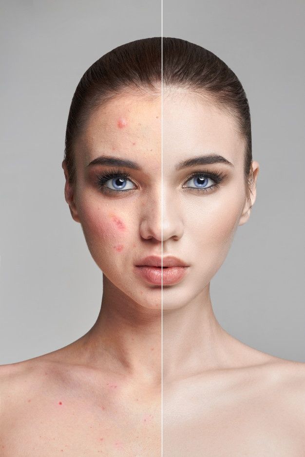 Acne Treatment